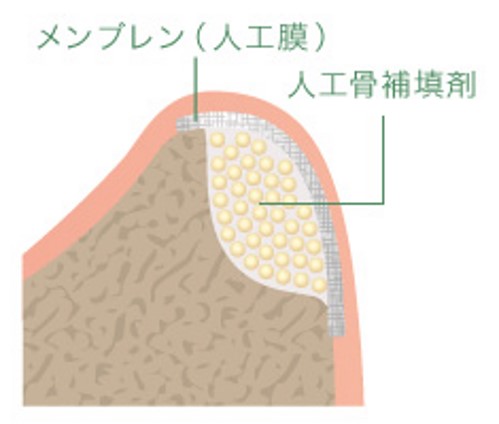 GBR・サイナスリフト