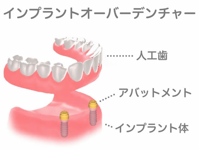 総入れ歯をインプラントで固定（インプラントオーバーデンチャーとは）